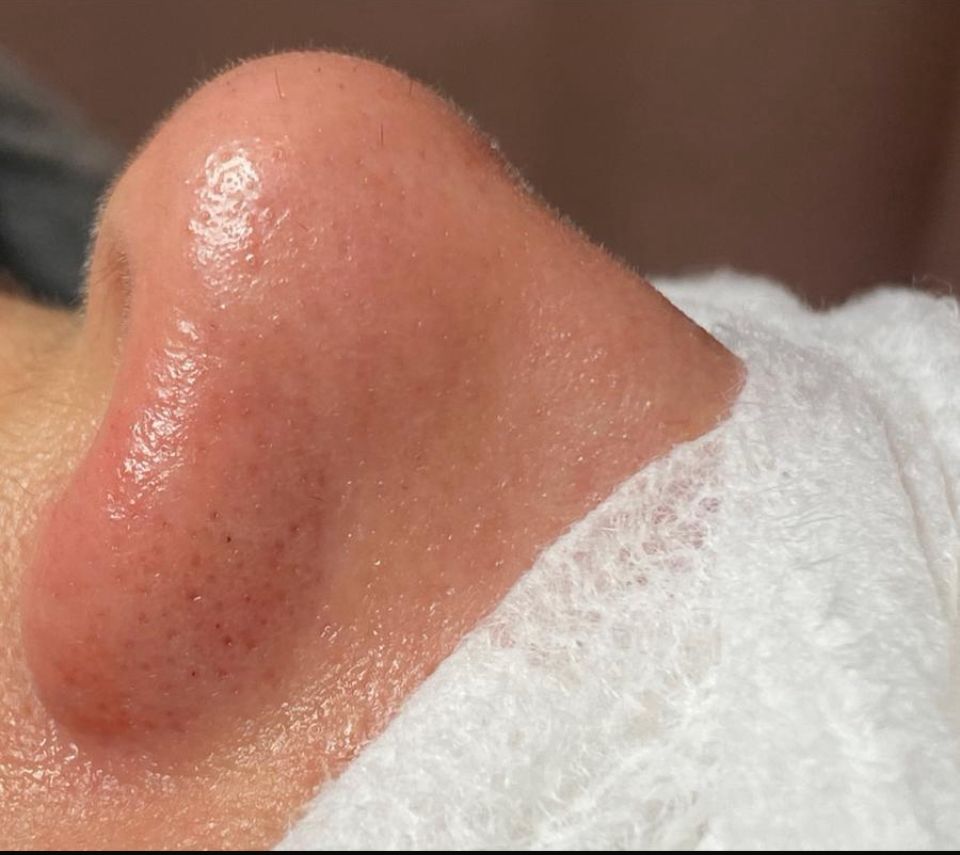 Resultado após tratamento