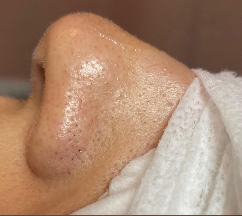 Estado antes do tratamento